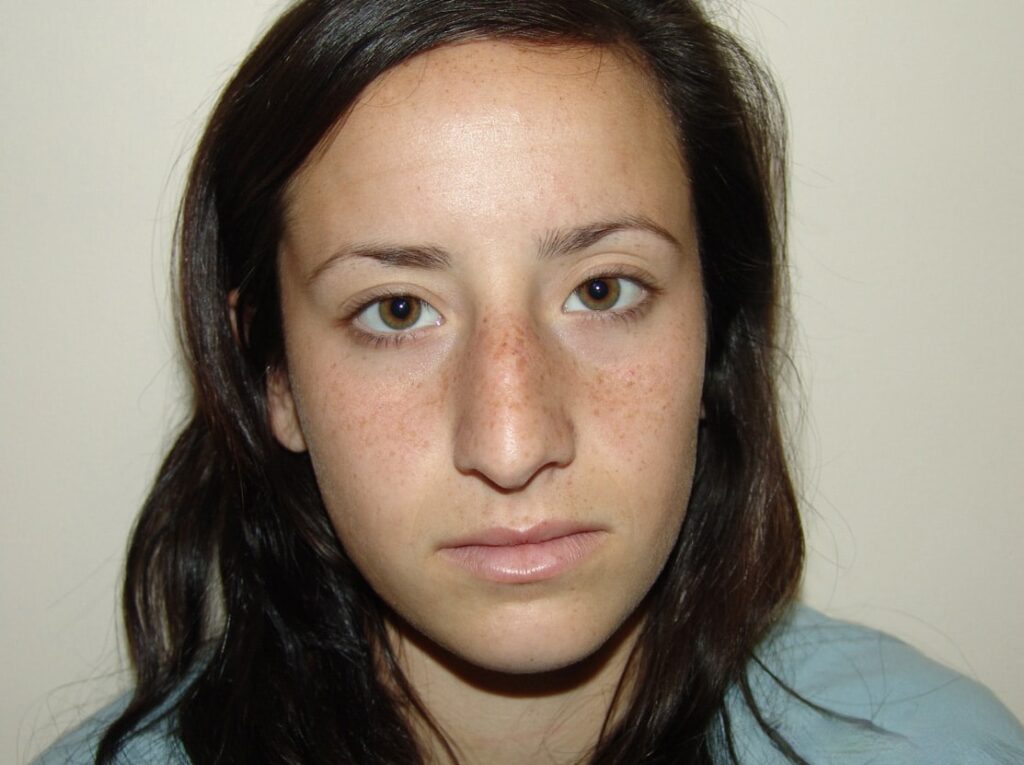 Before Image: Rhinoplasty - front