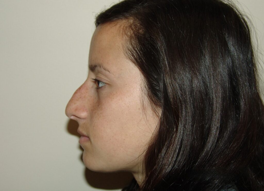 Before Image: Rhinoplasty - front
