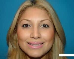 After Image: Rhinoplasty - front