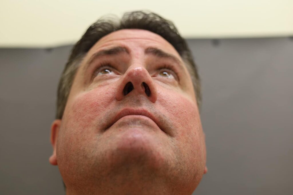 After Image: Rhinoplasty - front