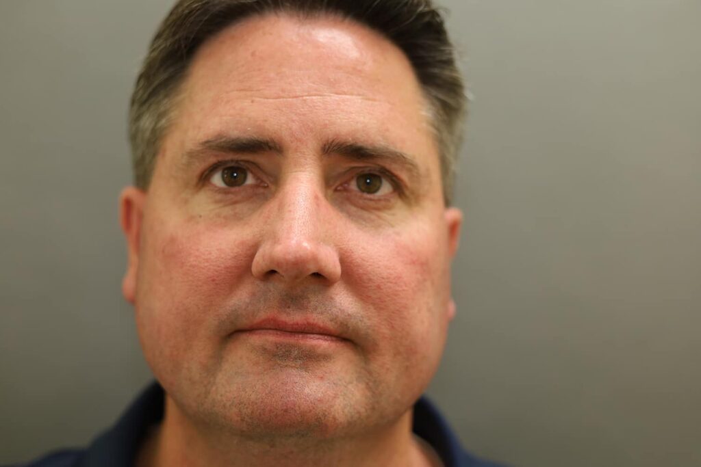 Before Image: Rhinoplasty - front