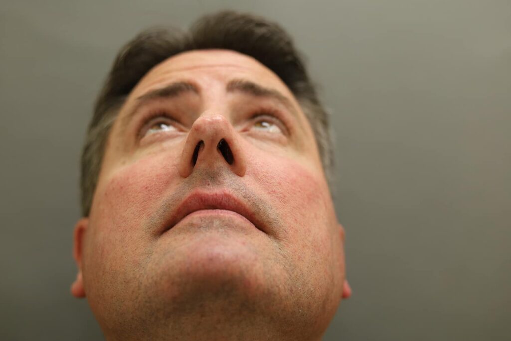 Before Image: Rhinoplasty - front