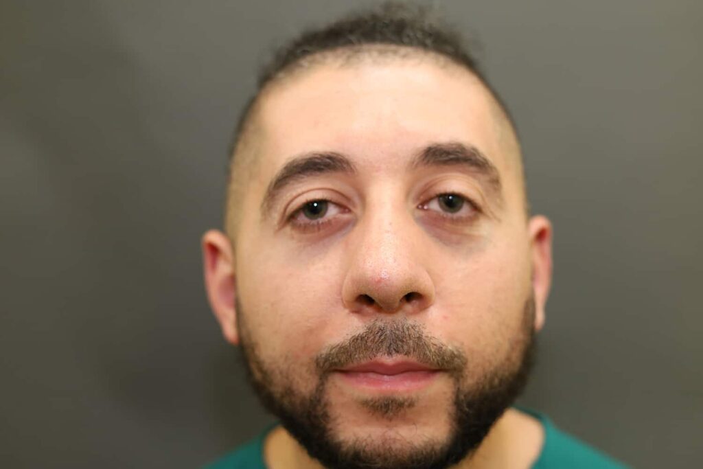After Image: Rhinoplasty - front