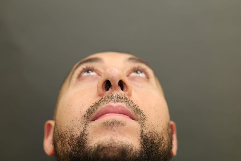 After Image: Rhinoplasty - front