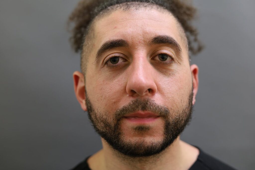 Before Image: Rhinoplasty - front