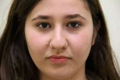 Before Image: Rhinoplasty - front
