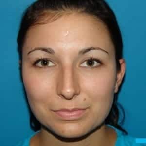 After Image: Rhinoplasty - front