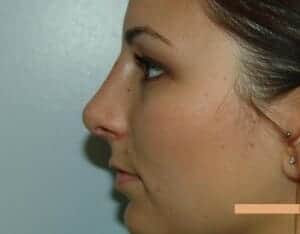 After Image: Rhinoplasty - left-side