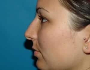 Before Image: Rhinoplasty - left-side