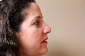 After Image: Rhinoplasty - right-side