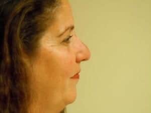 Before Image: Rhinoplasty - right-side