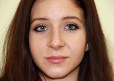 After Image: Rhinoplasty - front