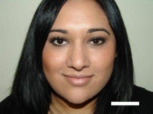 After Image: Rhinoplasty - front