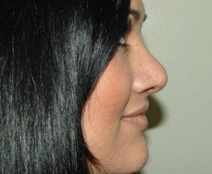 After Image: Rhinoplasty - right-side