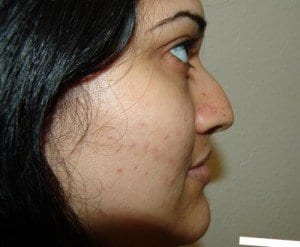Before Image: Rhinoplasty - right-side
