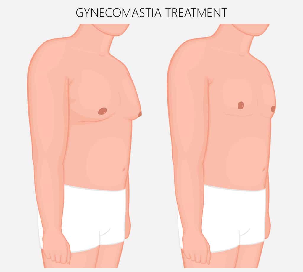 Illustrated diagram shows gynecomastia treated with surgery for slimmer profile.