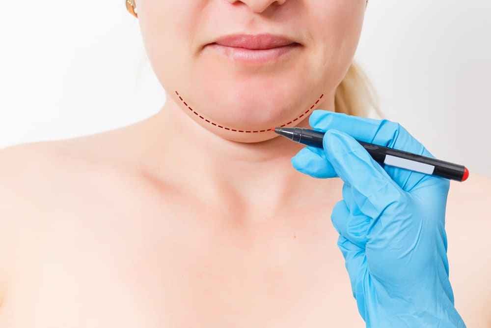 Neck Liposuction in San Diego & Coronado, CA 15 1774481937 3232003eb70d4e5d991f576d48495602 1 updated